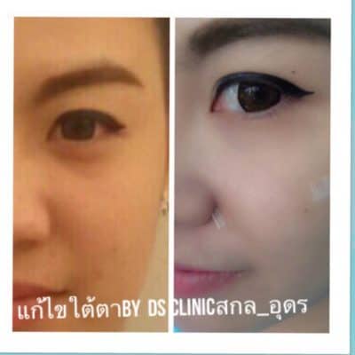 filler ใต้ตา