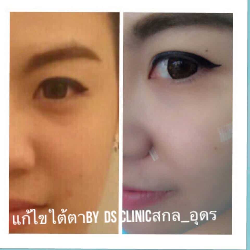 filler ใต้ตา