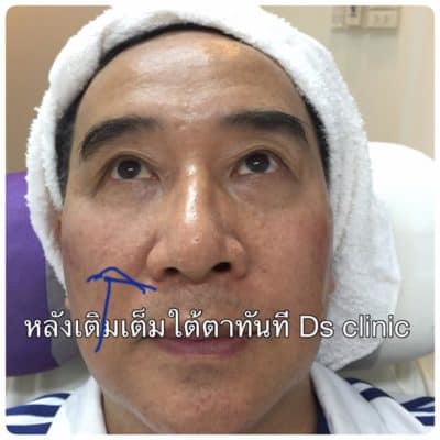 fillerใต้ตา