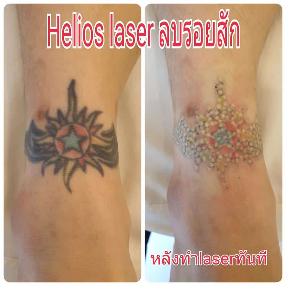 ลบรอยสัก