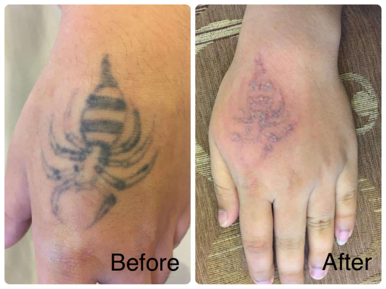 ลบรอย สัก