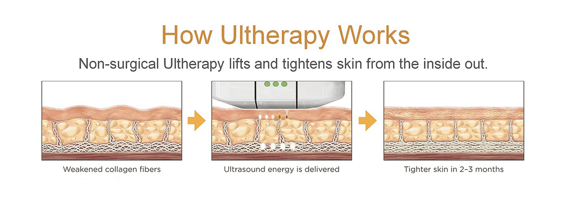 How works c. Ulthera System логотип. Ulthera протоколы. Ультразвуковой смас лифтинг схема. Смас лифтинг принцип принцип действия.