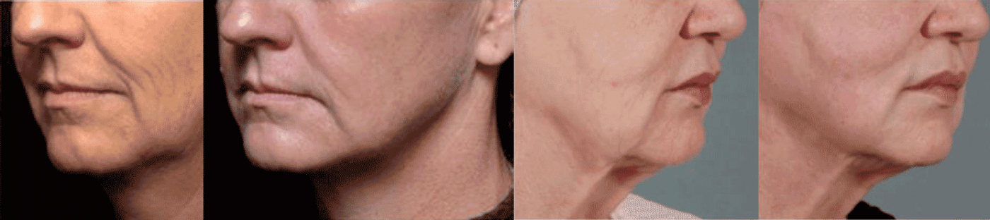 ultherapy_dsclinic