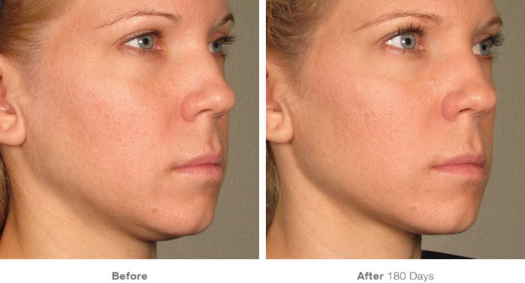 before_after_ultherapy_dsclinic