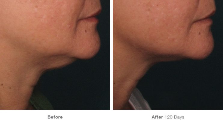 before_after_ultherapy_dsclinic