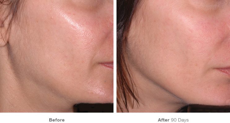 before_after_ultherapy_dsclinic