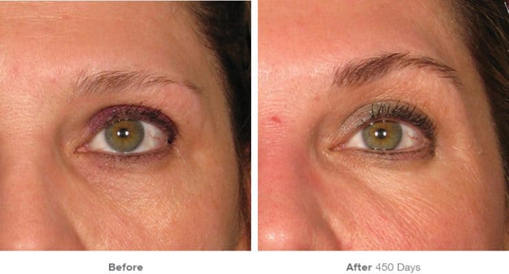 before_after_ultherapy_dsclinic