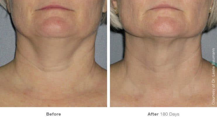 before_after_ultherapy_dsclinic