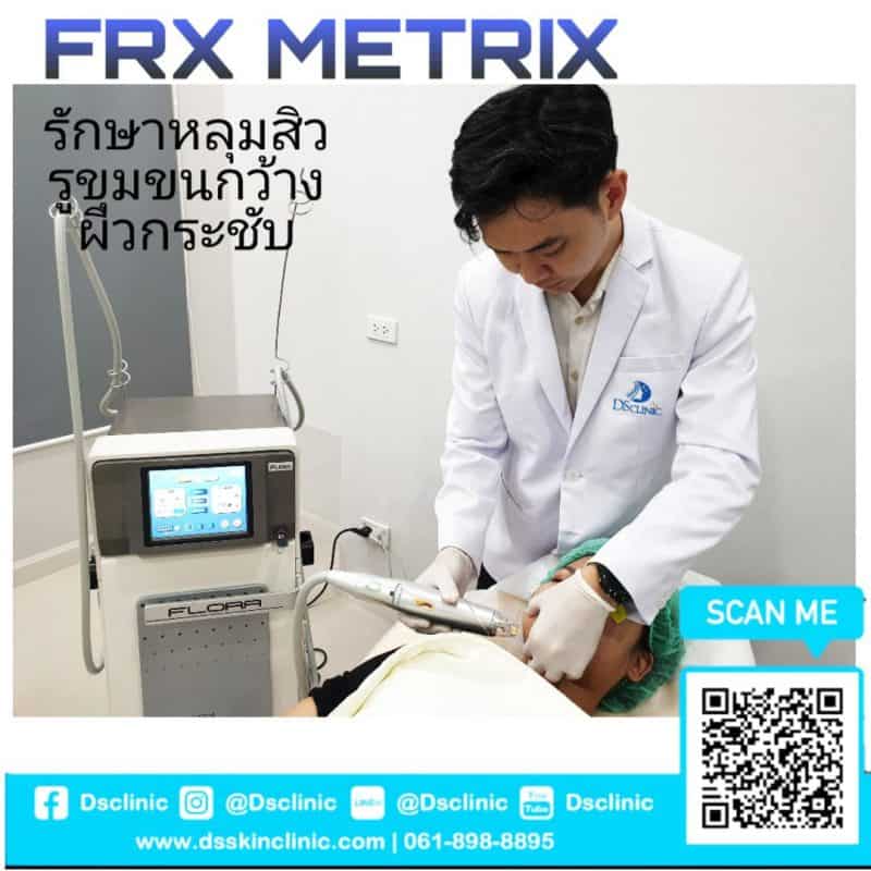 เลเซอร์หลุมสิว