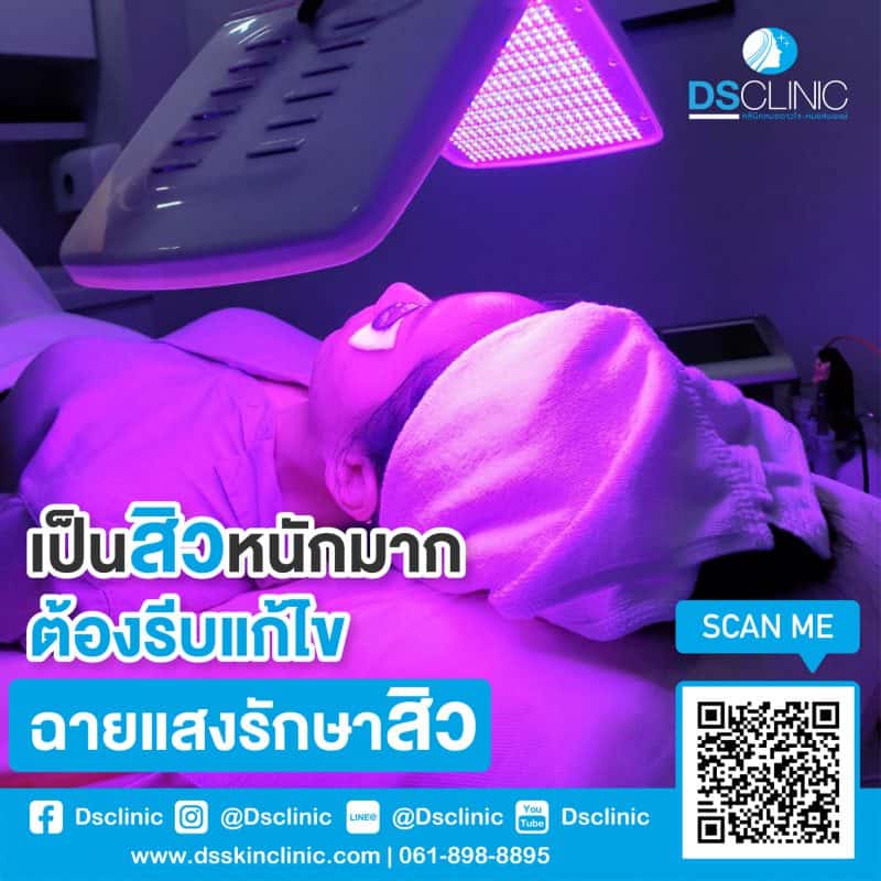 เลเซอร์ FRX matrix สำหรับรักษาหลุมสิว ช่วยให้ผิวเรียบเนียนและลดรอยแผลเป็นอย่างมีประสิทธิภาพ.