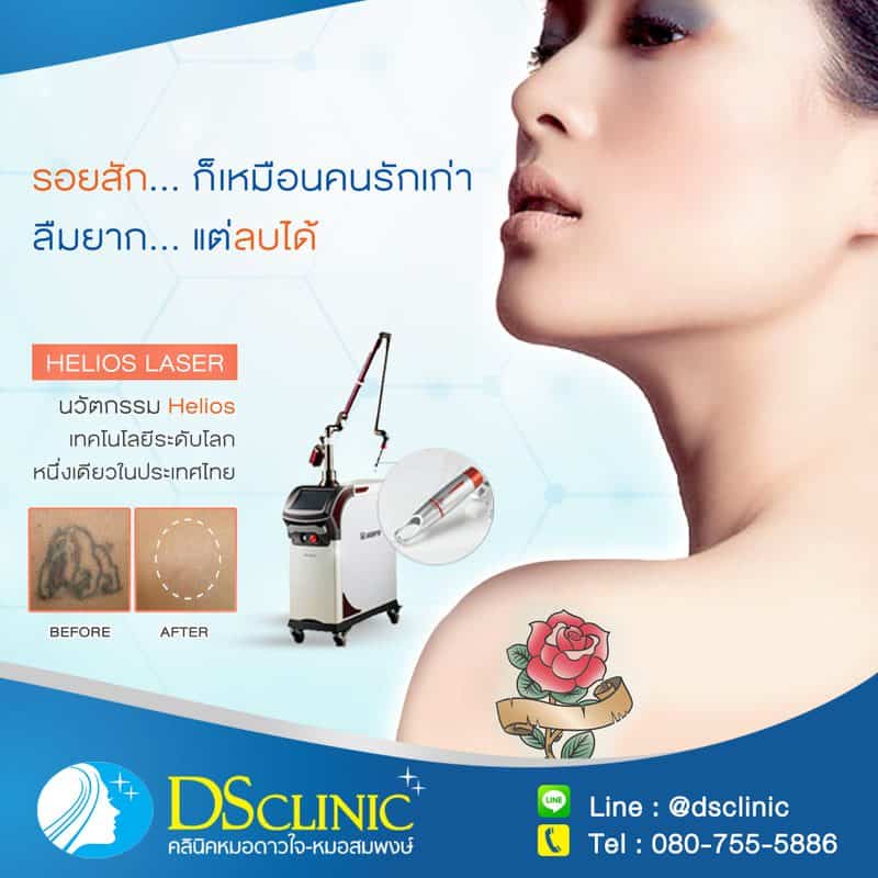 การลบรอยสักด้วยเลเซอร์อย่างปลอดภัยและมีประสิทธิภาพโดยแพทย์ผู้เชี่ยวชาญ.