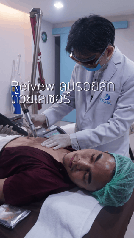 tattoo removal laser