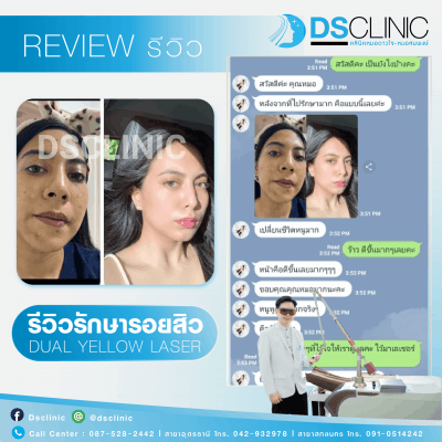 dsclinic review สิว