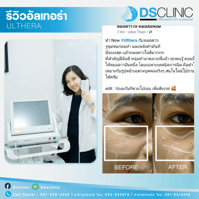 Ulthera dsclinic