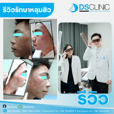 หลุมสิว dsclinic