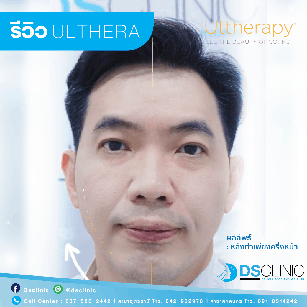 review ulthera