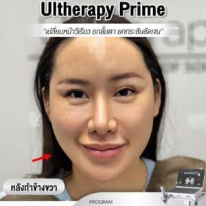 ฟิลด์ที่ 2: ผลลัพธ์ Ultherapy Prime ช่วยยกกระชับผิวหน้าให้เรียวขึ้นอย่างเป็นธรรมชาติ.