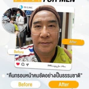 การทำ Ultherapy สำหรับผู้ชายก่อนและหลังการรักษา.
