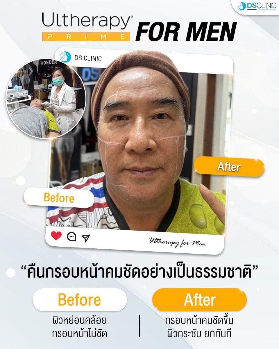 การทำ Ultherapy สำหรับผู้ชายก่อนและหลังการรักษา.