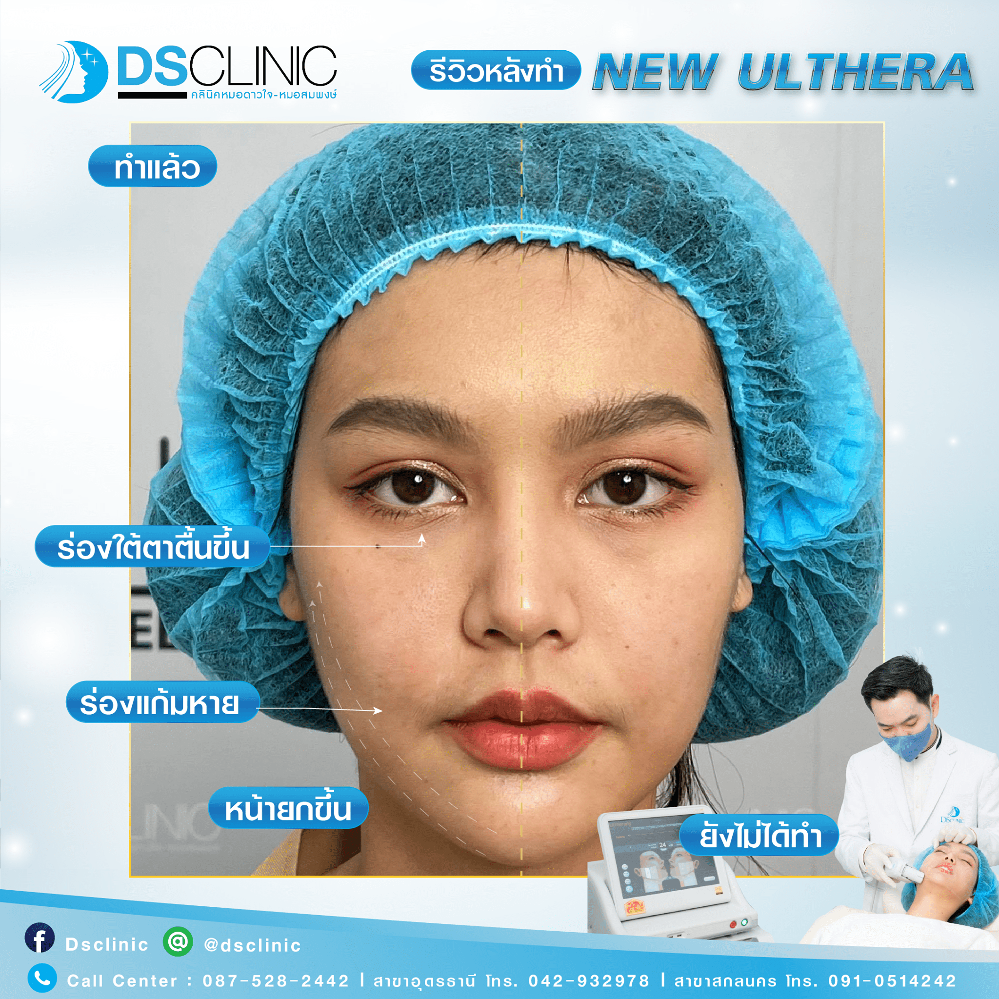 ulthera dsclinic