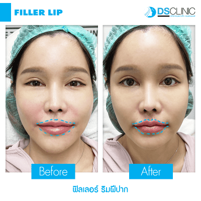 ิฟิลเลอร์ปาก