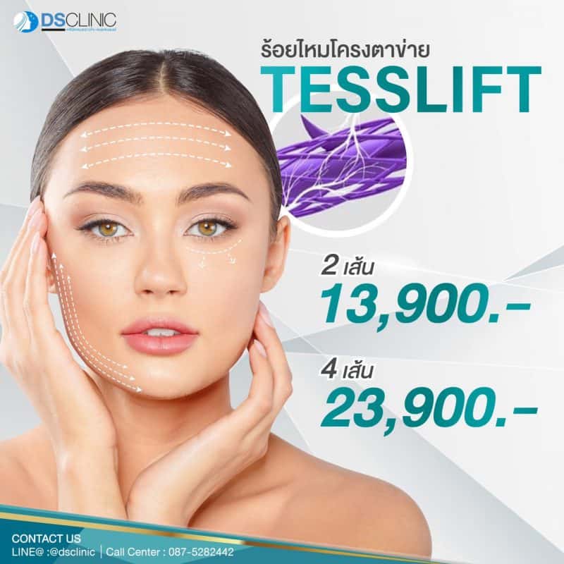 โปรโมชั่น ร้อยไหม