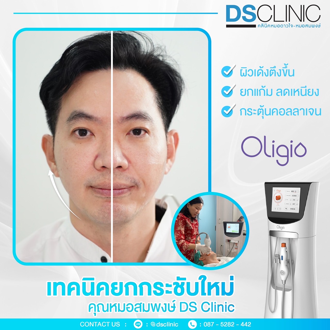 เทคนิคยกกระชับ