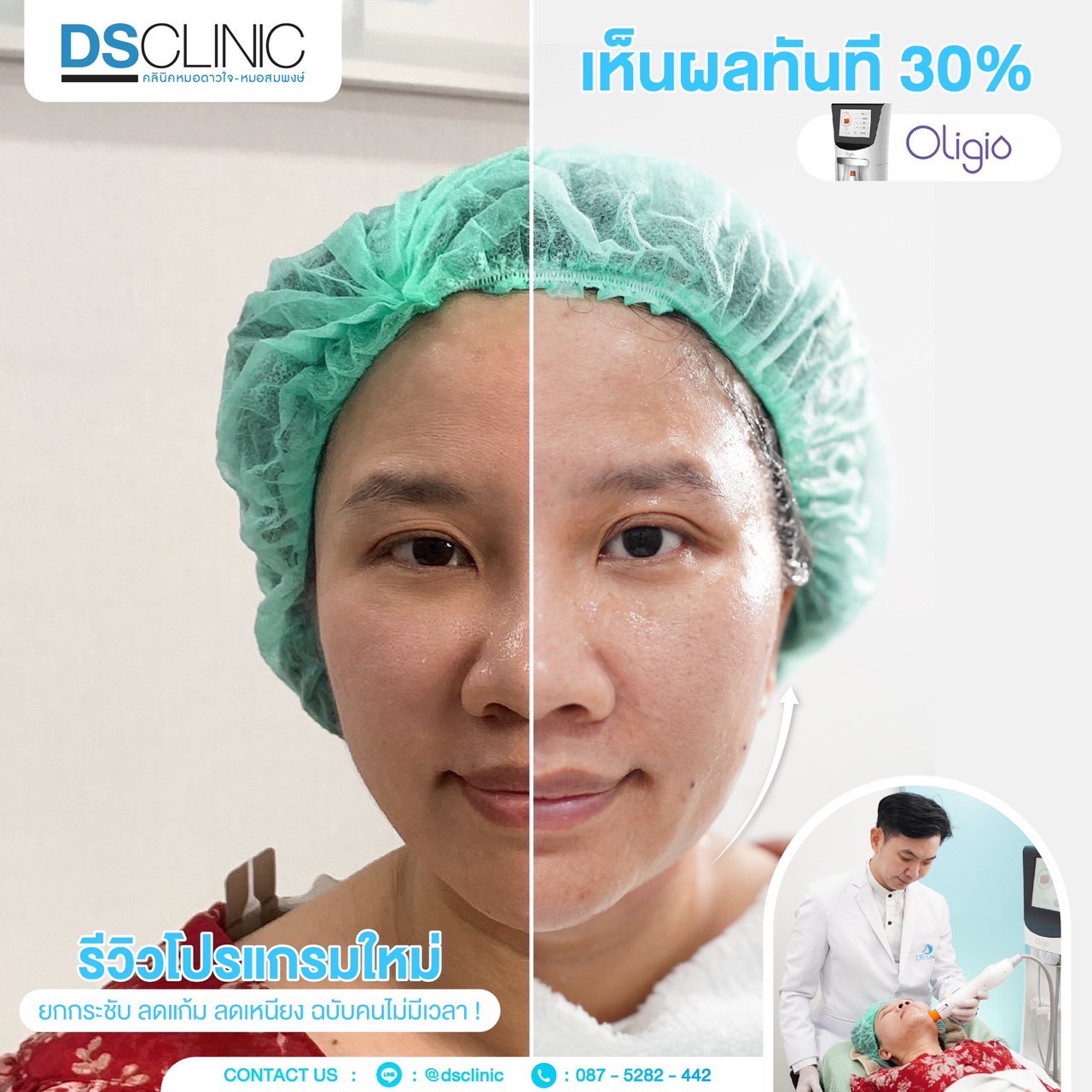 เห็นผลทันที oligio