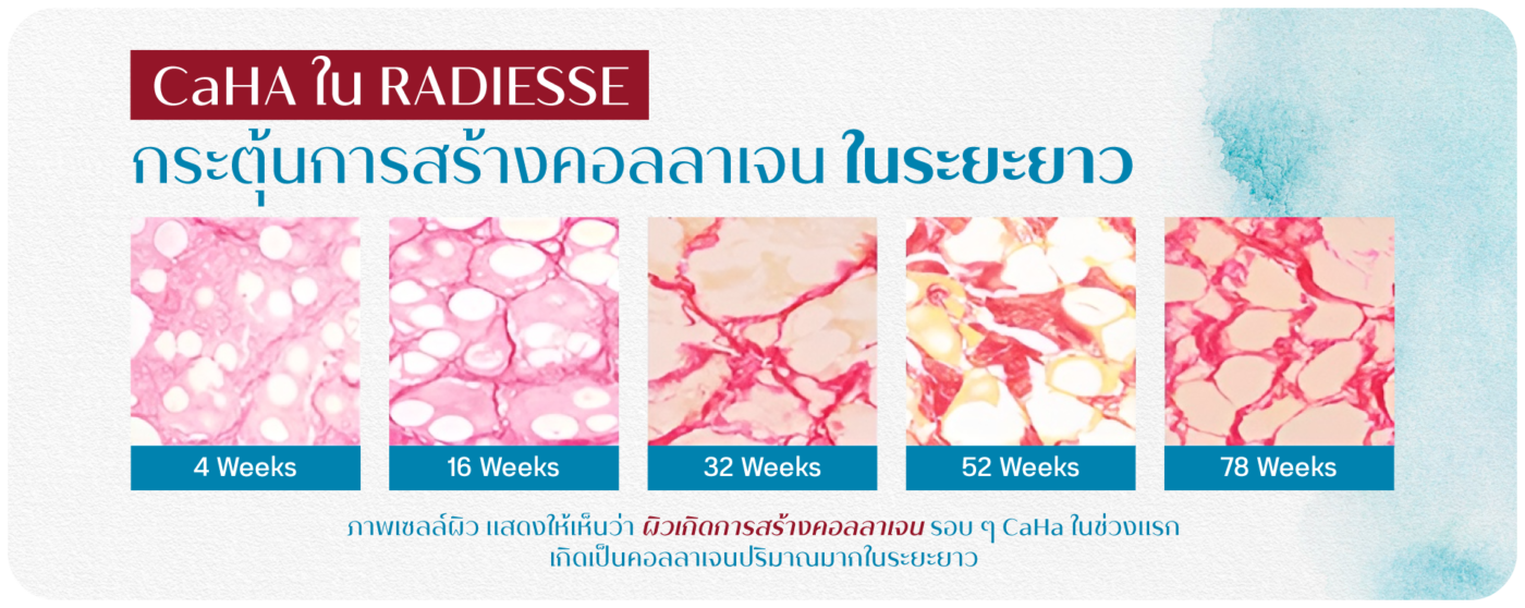 Radiesse Fillerกระตุ้นการสร้างคอลลาเจน