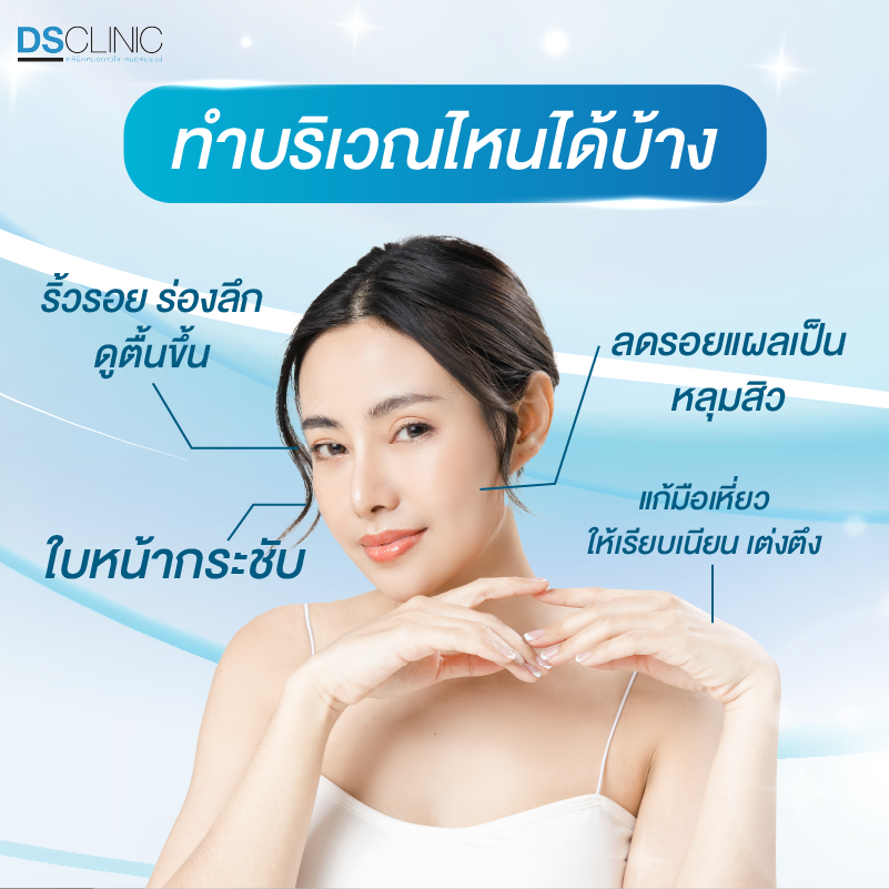 Fillerทำบริเวณไหนได้บ้าง