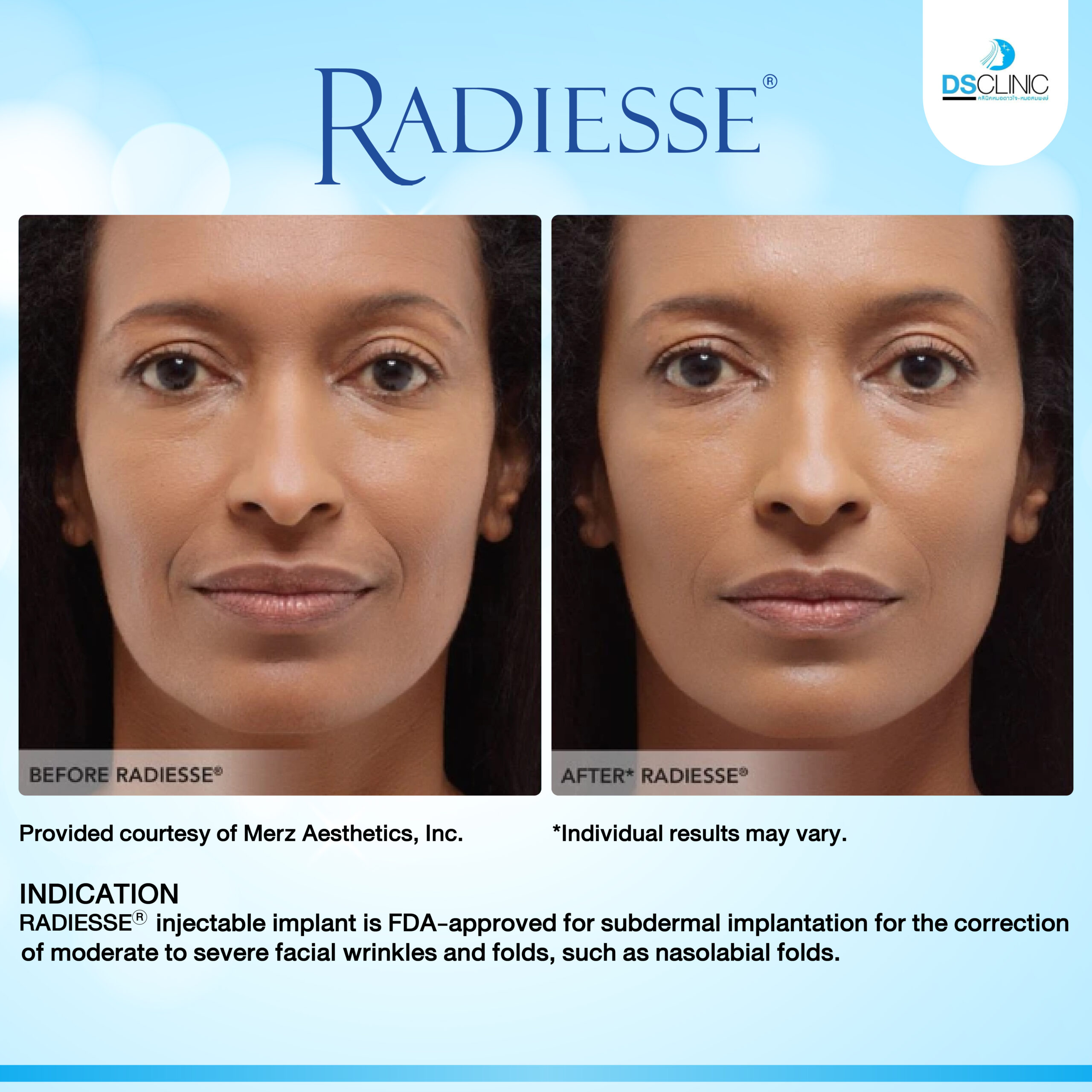 Before After Radiesse