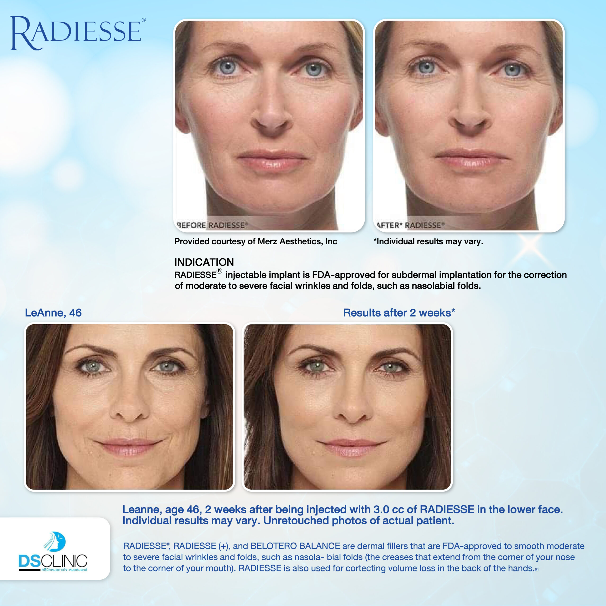 Before After Radiesse