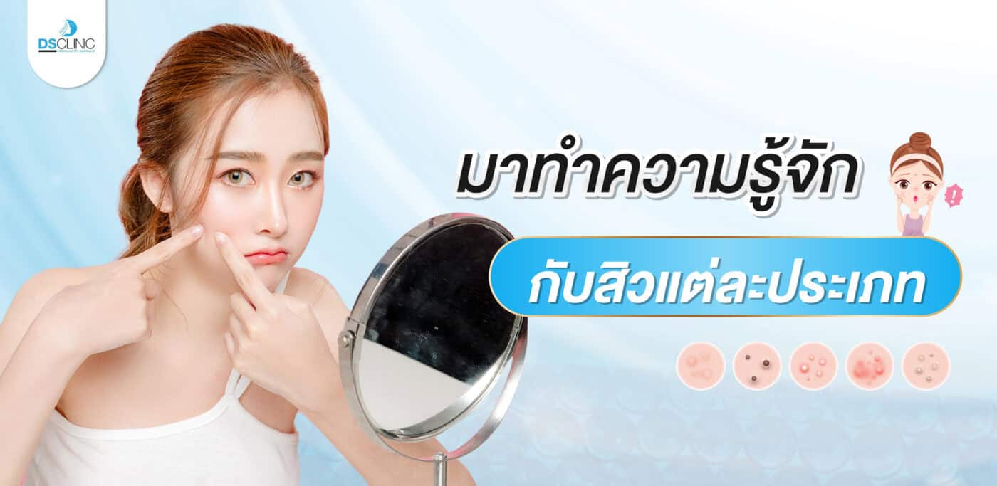 มาทำความรู้จักกับสิวแต่ละประเภท