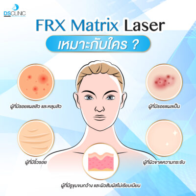 FRX Matrix Laser เหมาะกับใคร