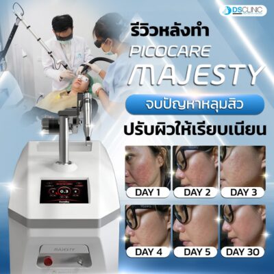 Pico Majesty Laser Review