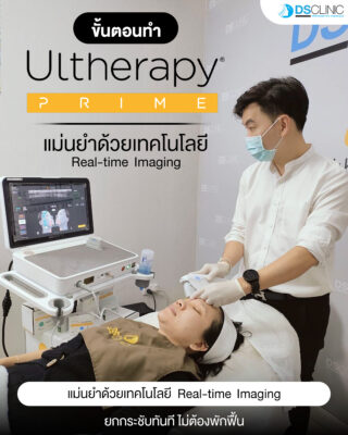 ultherapy prime