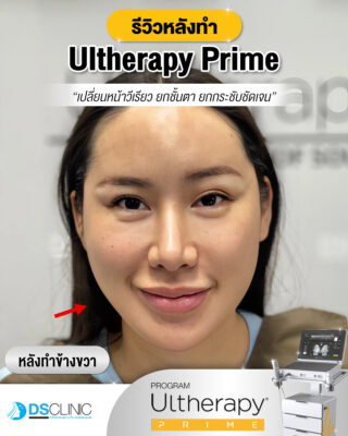 ultherapy prime