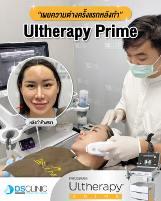 ultherapy prime