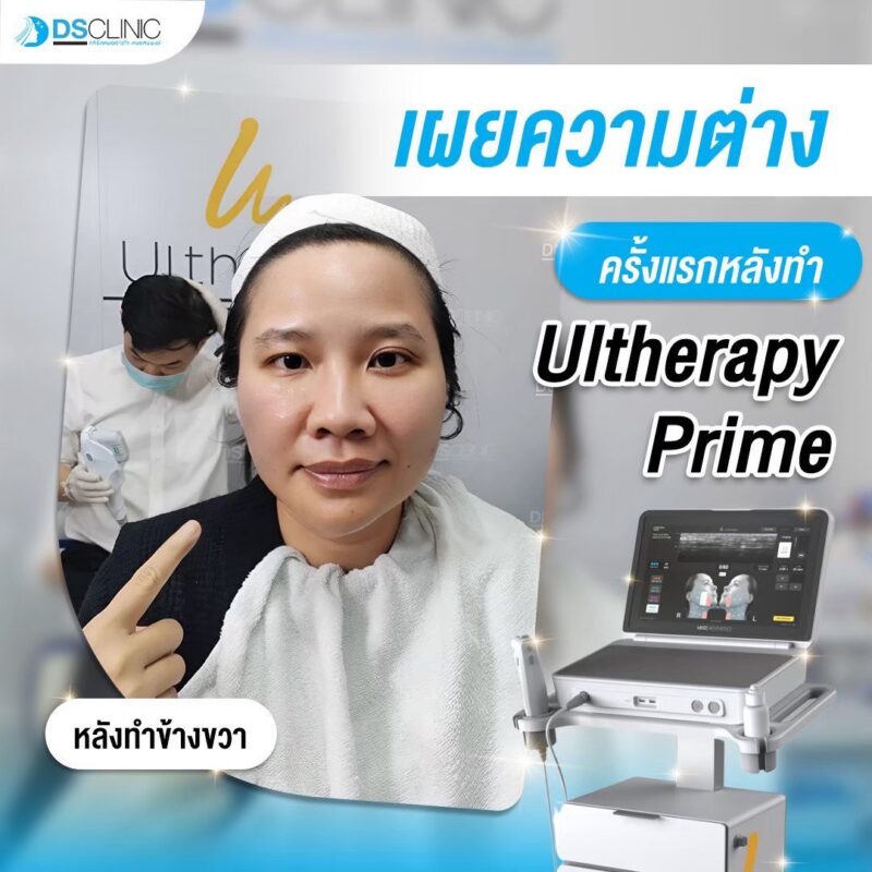 รีวิว Ultherapy Prime เปรียบเทียบหลังทำทันทีครึ่งหน้า DS Clinic
