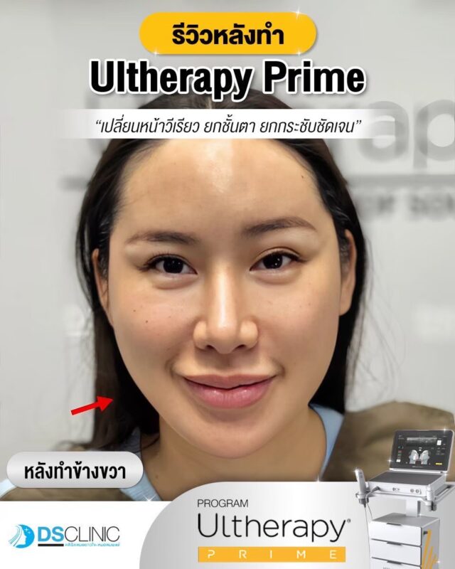 ผลลัพธ์ Ultherapy Prime ยกกระชับหน้าเรียว V-Shape และยกหางตา