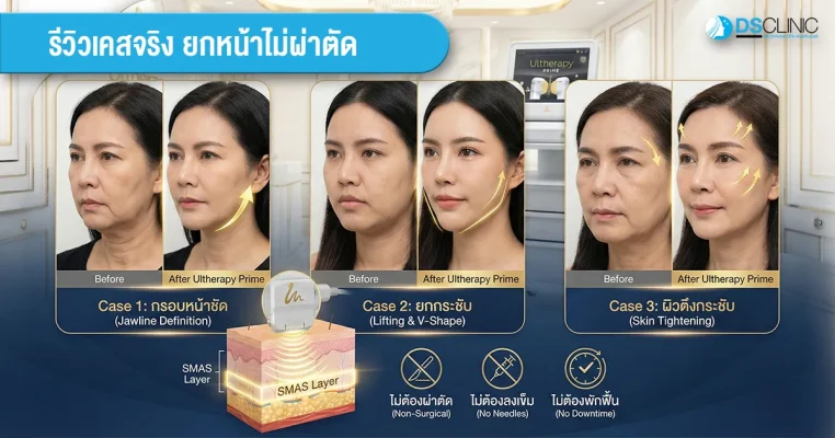 รีวิวผลลัพธ์ Ultherapy Prime จาก DS Clinic