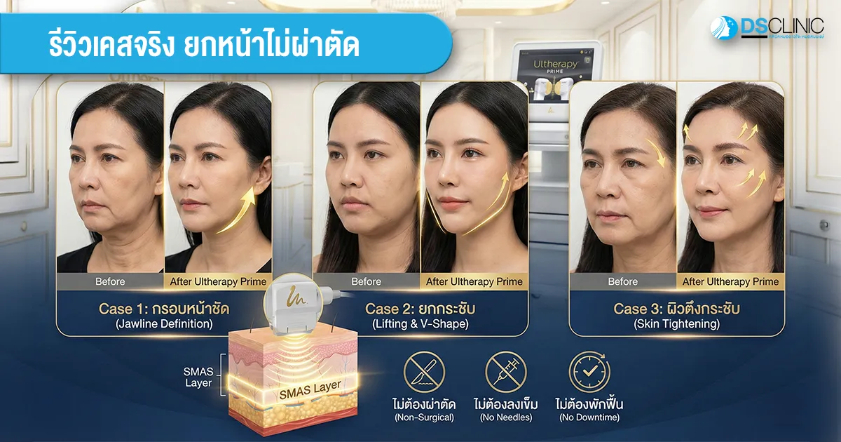 รีวิวผลลัพธ์ Ultherapy Prime จาก DS Clinic