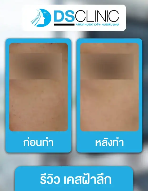 เปรียบเทียบผิวหน้าก่อนและหลังทำเลเซอร์ฝ้าลึกที่ DS Clinic.