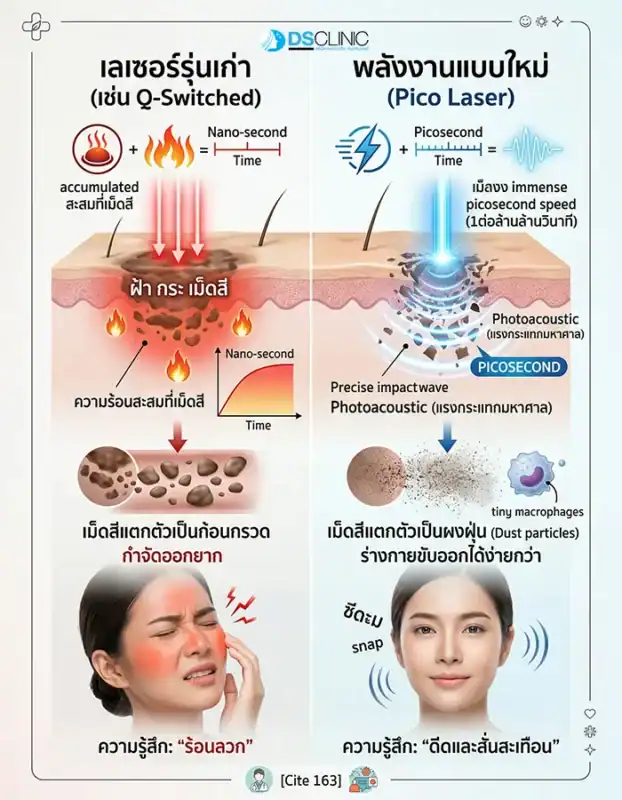 อินโฟกราฟิกเปรียบเทียบการทำงานของเลเซอร์รุ่นเก่า (Q-Switched) ที่ใช้ความร้อน กับ Pico Laser ที่ใช้แรงกระแทกความเร็วสูงทำให้เม็ดสีแตกตัวเป็นผงฝุ่น