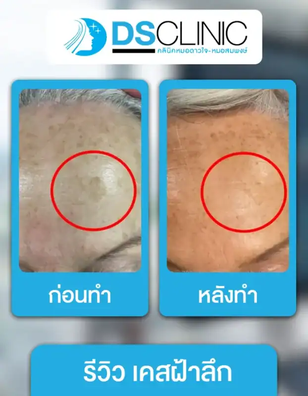 ฝ้าลึกและจุดด่างดำลดเลือนชัดเจนหลังรับการรักษาด้วยเทคโนโลยีเลเซอร์ที่ปลอดภัยและได้ผลจริง.