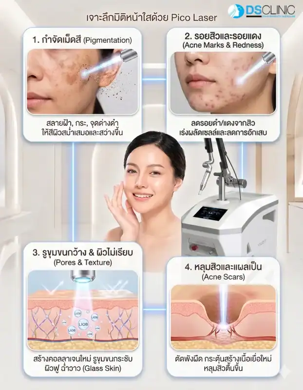 เทคโนโลยี Pico Laser สำหรับผิวใสและลดรอยสิว.