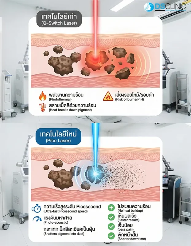 แผนภาพเปรียบเทียบความแตกต่างระหว่างเทคโนโลยี Q-Switch แบบเก่าที่ใช้ความร้อน กับ Pico Laser แบบใหม่ที่ใช้แรงดันมหาศาลสลายเม็ดสีให้เป็นฝุ่น