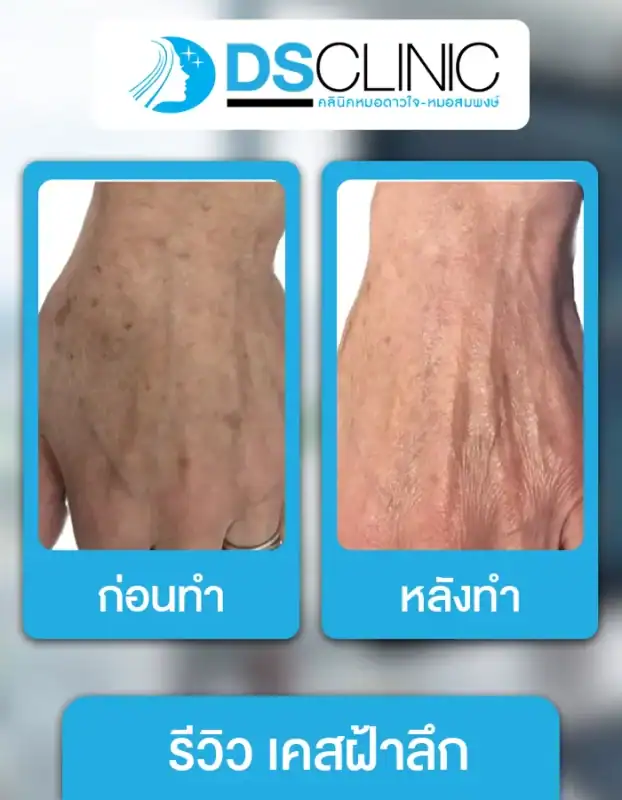 ฝ้าลึกและจุดด่างดำบนผิวหนังถูกแก้ไขด้วยเทคโนโลยีเลเซอร์ที่ปลอดภัยและได้ผลจริงที่ DS Clinic.
