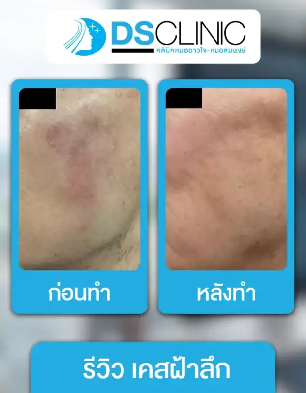 ฝ้าลึกและจุดด่างดำลดลงอย่างเห็นได้ชัดหลังการรักษาด้วยเทคโนโลยีเลเซอร์ที่ปลอดภัยและได้ผลจริง.