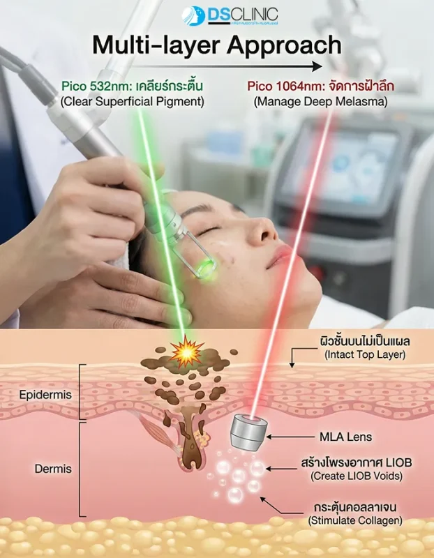 การรักษาแบบ Multi-layer ด้วย Pico Laser ใช้ MLA Lens สร้างโพรงอากาศ LIOB ในชั้นผิวเพื่อกระตุ้นคอลลาเจนและรักษาหลุมสิว